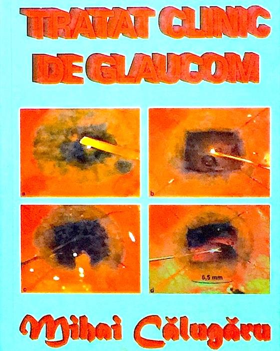 Tratat clinic de glaucom
